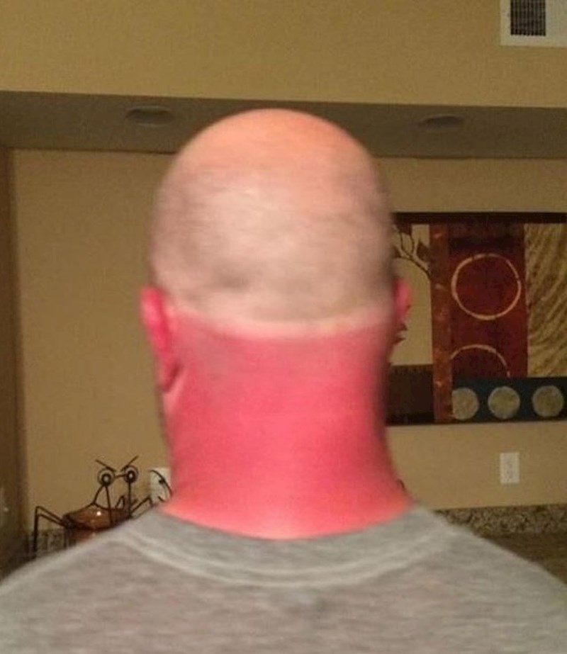 Zaštitio se od sunca... djelomično.