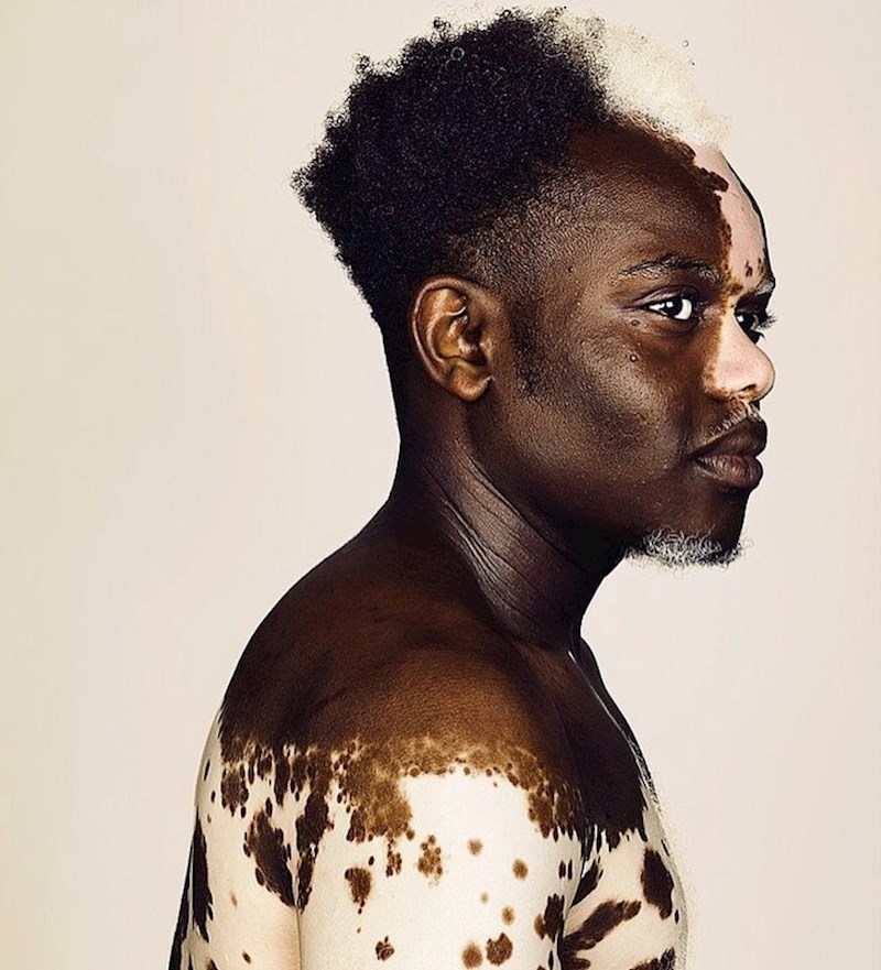 Priroda je neke ljude obojila i dala im zanimljive šare...