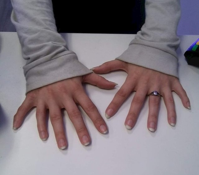 Žena joj je došla na ugradnju noktiju. Imala je 12 prstiju.