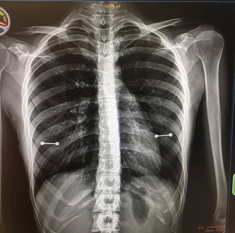 "Mama je htjela vidjeti moju rendgensku sliku. Prekasno sam primijetila da se na njoj vide piercinzi na mojim bradavica. Nisam htjela da to sazna."