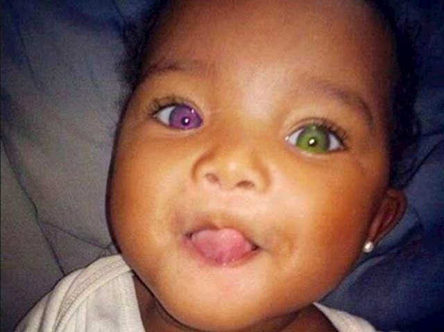 Beba s različitim bojama očiju