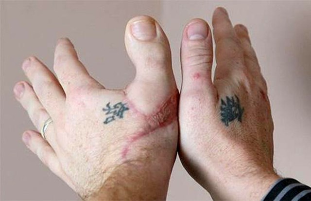 Ova osoba je ostala bez palca pa su joj transplantirali prst s noge.