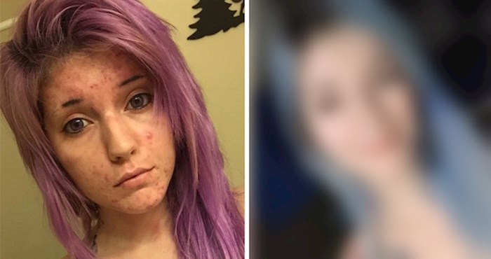 Ovu 25-godišnjakinju su nazvali lažljivicom jer nisu mogli vjerovati da je izliječila grozan problem s aknama