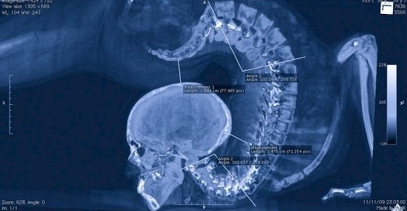 Napravili su rendgensku snimku osobe koja se može uvijati na nevjerojatan način.