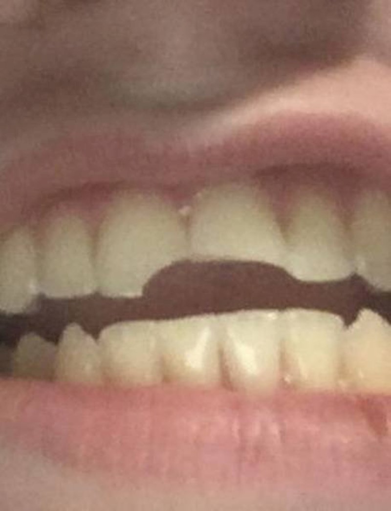 "Razbio sam se kad sam krenuo na WC, slomio sam oba prednja zuba."