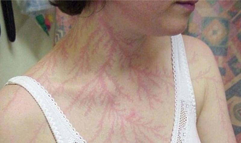 Ljudsko tijelo može preživjeti udar munje. Zapravo, neke statistike kažu da većina ljudi preživi.