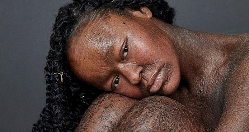 Žena kojoj se koža guli svaka dva tjedna vjerojatno je prvi fotomodel s ovim problemom