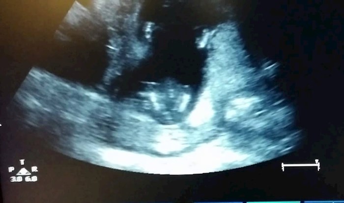 VIDEO Mladi par je gledao svoju bebu na ultrazvuku, a onda su primijetili nešto simpatično