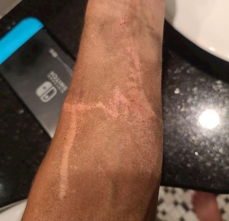 "Primijetio sam da mi se ožiljak nikad ne isprlja."