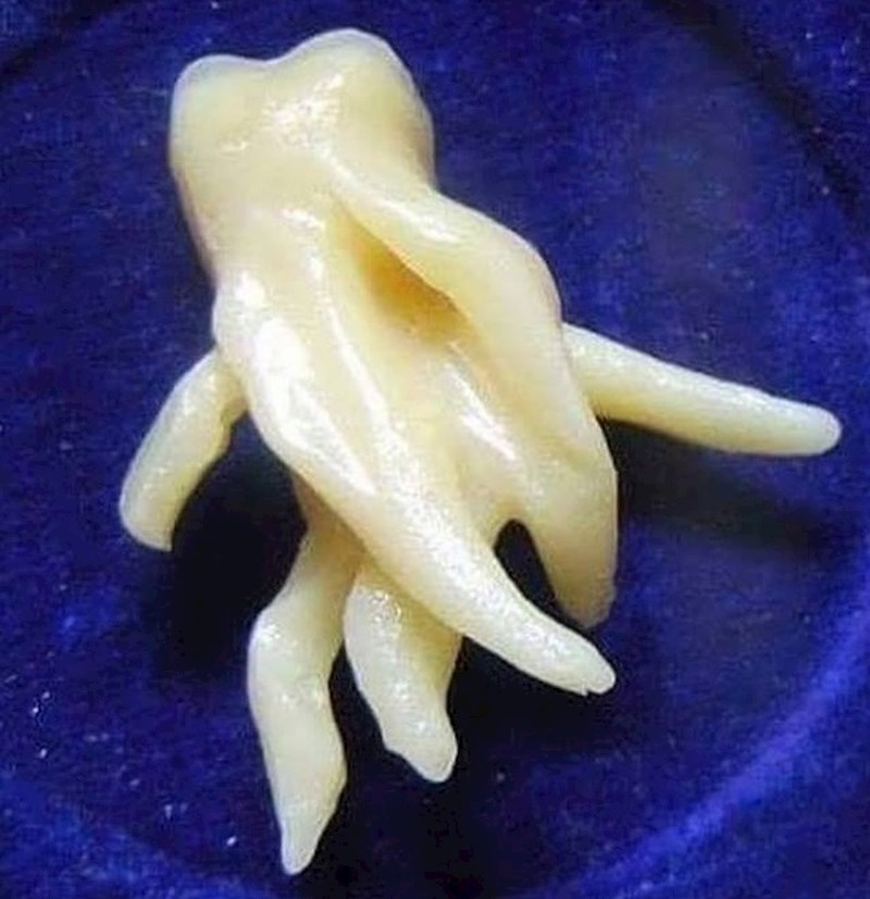 Noćna mora svakog zubara. Da, ovo je stvarno bio nečiji zub.