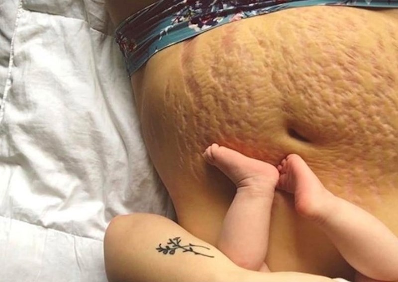 Tragovi trudnoće i poroda pokazuju koliko je tijelo žene zapravo jako.