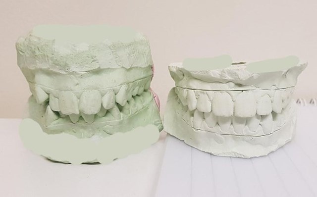 Isti zubi prije i nakon nošenja fiksnog aparatića