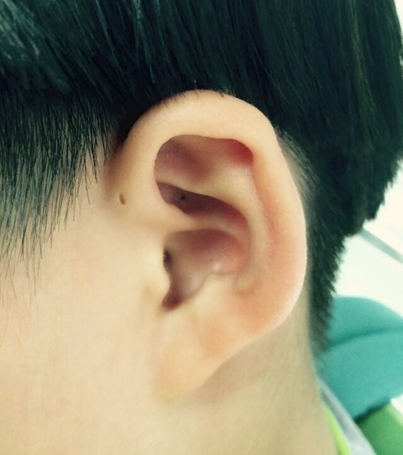 Neki ljudi još od rođenja imaju male rupice kod ušiju.