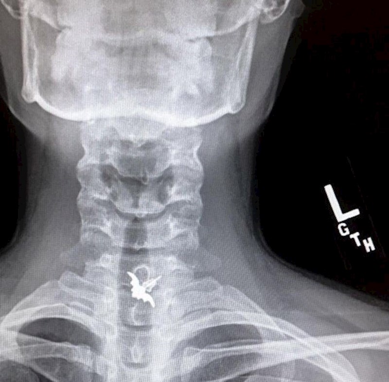 "Naušnica s malim šišmišem ušla je nekako u moj inhalator. Nakon 14 sati u bolnici postala sam poznata kao Batgirl."