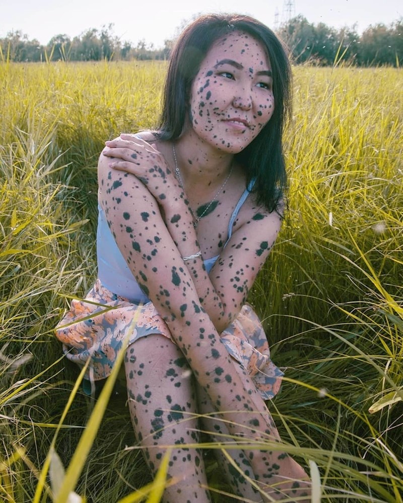 Ova djevojka ima velike madeže po cijelom cijelu.