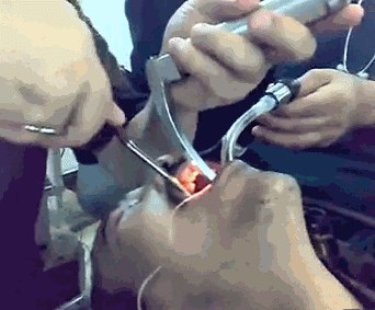 I DOKTORE JE ŠOKIRAO Ne, ovo nije vađenje zuba, pogledajte što su muškarcu izvadili iz usta