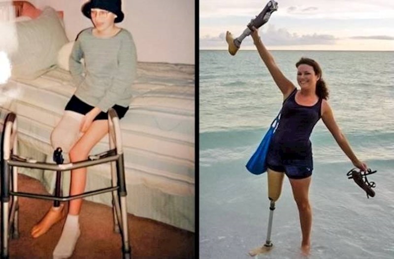 Kad je tek dobila protezu i danas