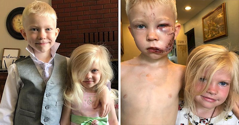 Šestogodišnjak je spasio sestru od napada psa, dobio je 90 šavova i pohvalu od "Osvetnika"