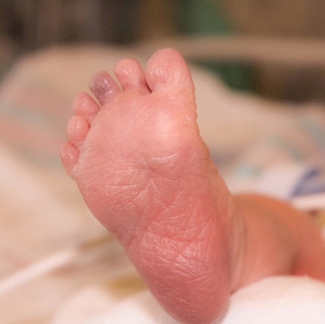 Ova bebica je rođena s ukupno 12 prstića na nogama.