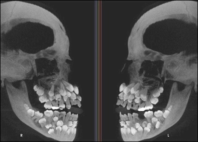 Ovo je rendgenska slika osobe koja ima višestruku hiperdonciju (višak zubi).