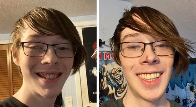 "Gotovo dvije godine sam se mučio s pokvarenim zubima. Konačno sam sve popravio i stavio implantate."