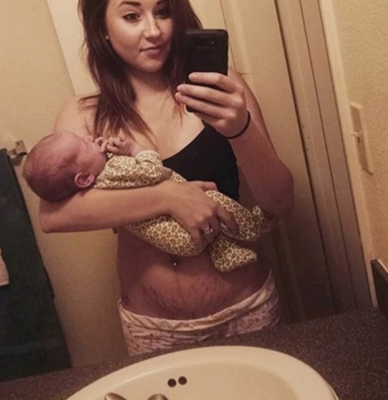 Strije su nešto sasvim normalno i očekivano.