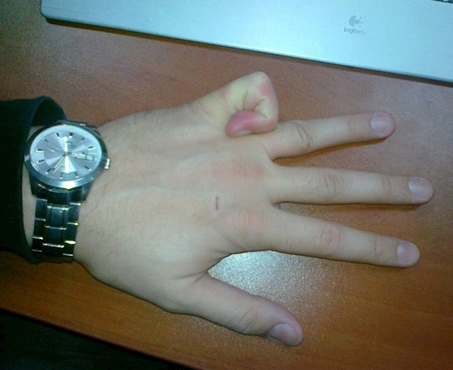 Ne, mali prst mu nije slomljen. :)