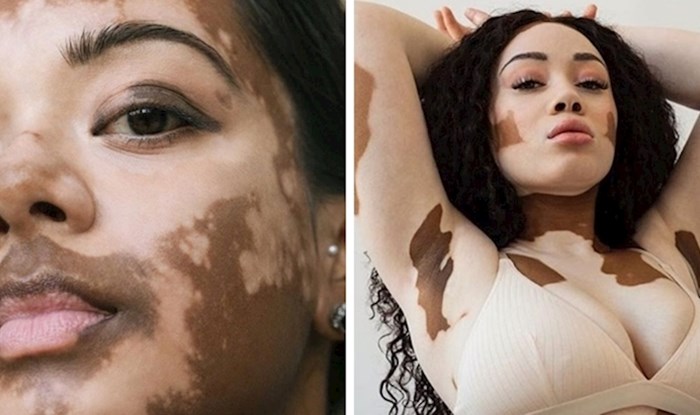 Fotografkinja s vitiligom slikala je žene s istim stanjem te naglasila njihovu unikatnu ljepotu