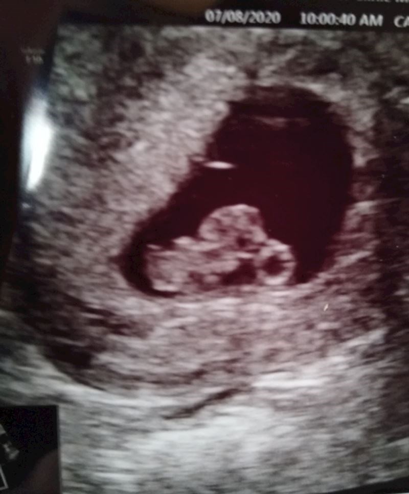 "Moja slika s ultrazvuka izgleda kao da netko u meni juri na motoru."