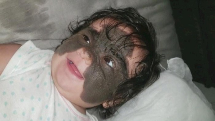 VIDEO Ova bebica je rođena s "Batman maskom" na licu, njeni roditelji su donijeli važnu odluku