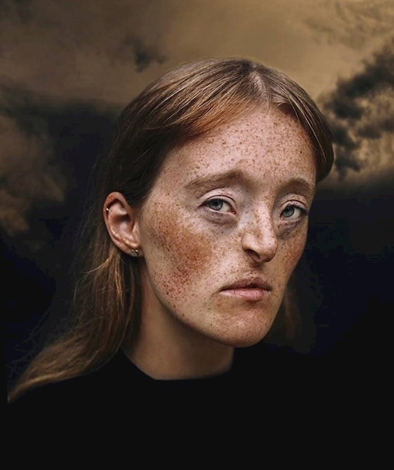 Ektodermalna displazija