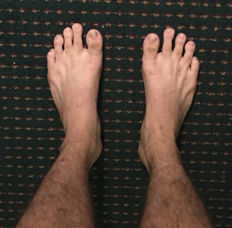 A ovaj muškarac ima jako kratke nožne palčeve.