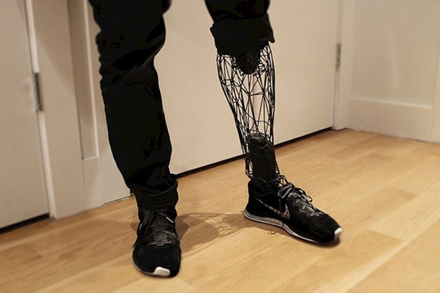 Ova osoba je dobila 3D protezu za nogu od titanija.