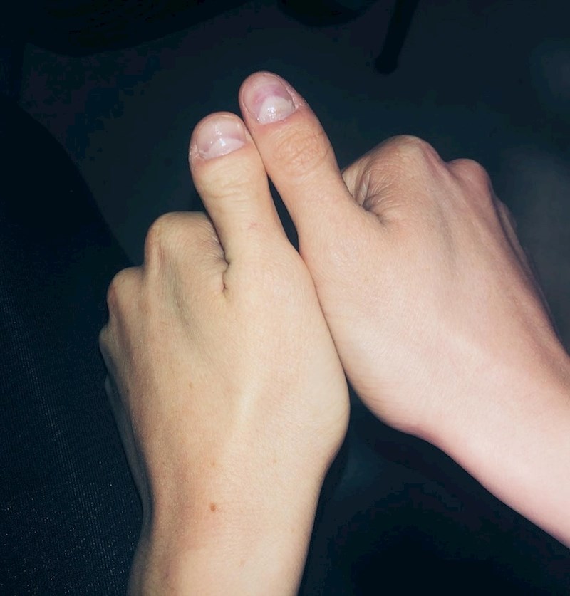 "Zbog genetske mutacije s tatine strane imam palčeve koji nisu jednaki."