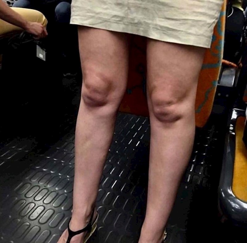 Ova žena izgleda kao da je zarobila bebe na mjestu gdje su koljena.