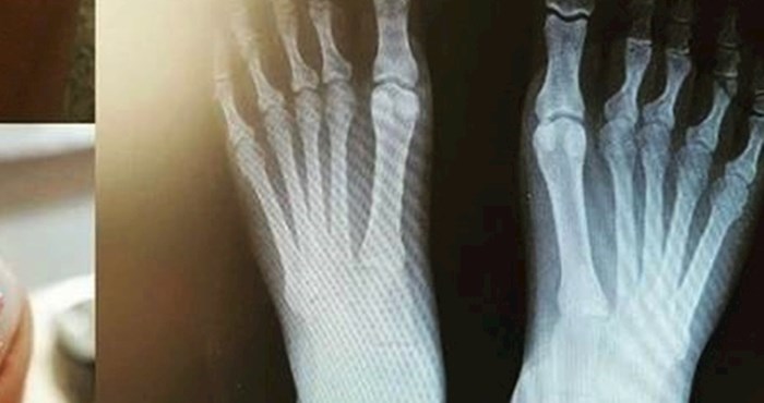 Žena je išla napraviti rendgenske slike stopala, doktor se smijao kad je vidio ovaj detalj