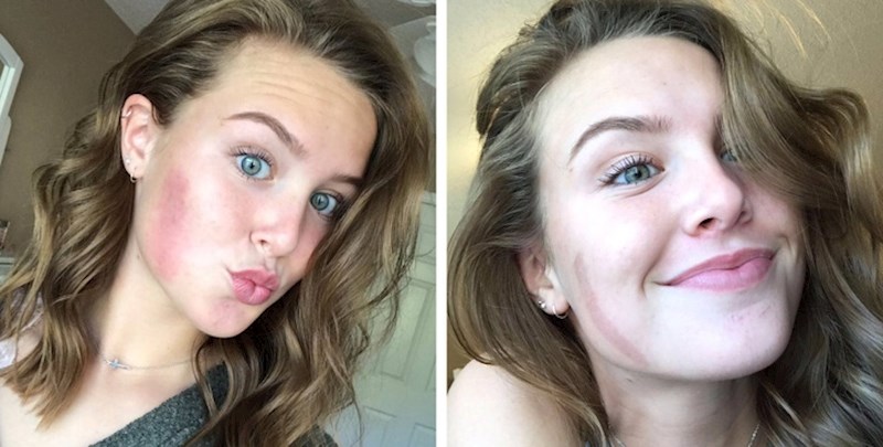 Mnoge žene na sebi imaju opekline i ožiljke. Uvijači za kosu su njihov neprijatelj.