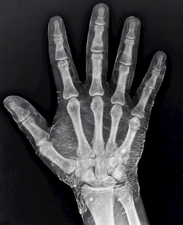 Ovo je rendgenska slika ruke umočene u jod. Jod utječe na sliku tako što prikazuje i mesnato tkivo oko kostiju.