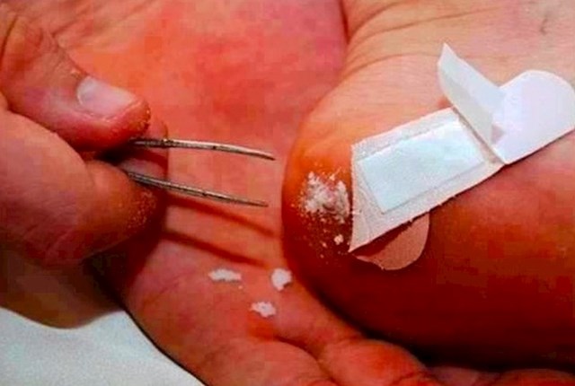 Kako bi odstranili žulj u kratkom roku, nanesite mješavinu sode bikarbone i vode i pričekajte nekoliko minuta.