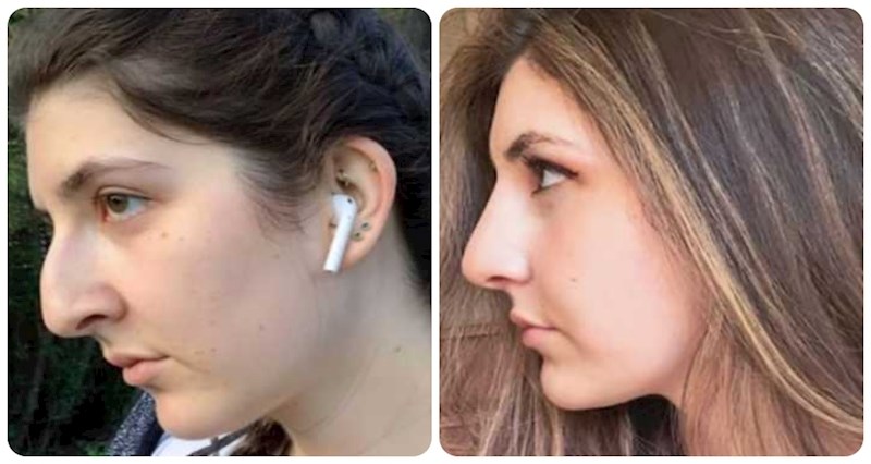 18 ljudi koji su se podvrgnuli estetskim operacijama i sad izgledaju fenomenalno