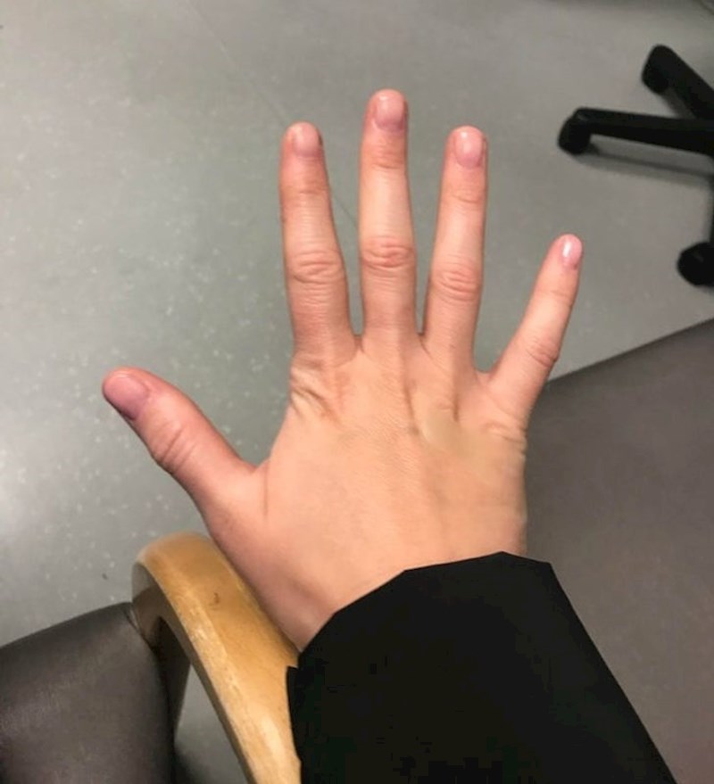 11. Na ruci imam flaster, možete li skužiti gdje?