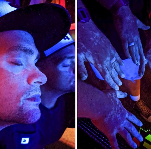 5. Ovako vitiligo izgleda pod neonskim svjetlima