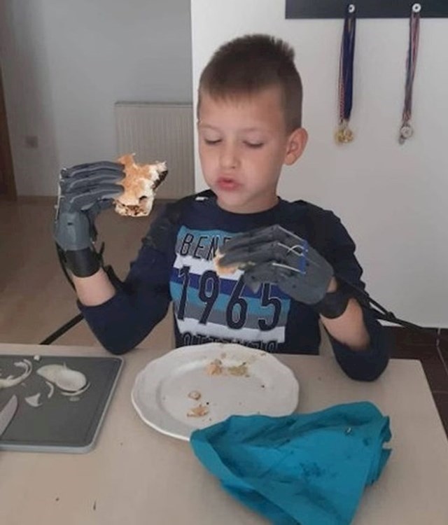 5. Dječak koji jede sa svojim prostetičkim rukama.