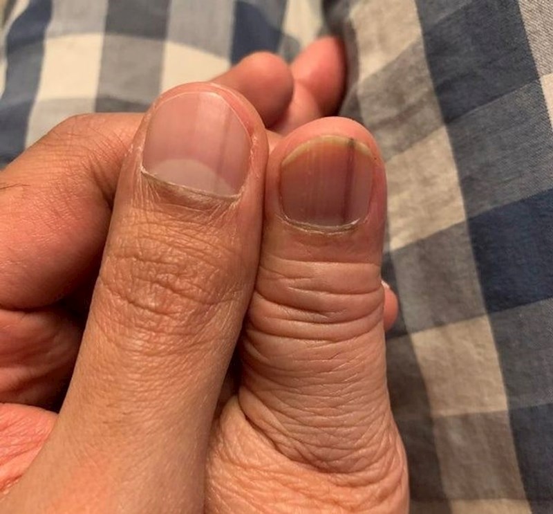 5. Majka i sin imaju crtu na noktu i to na istom mjestu.