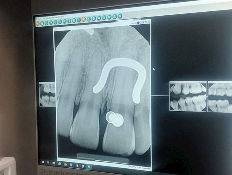 9. "Moji pirsevi pod rendgenom."