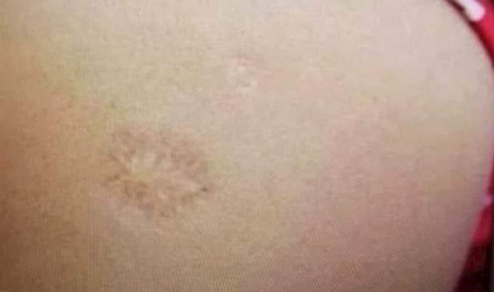 Netko je konačno objasnio što znači ako na ramenu imate ovakav ožiljak od cijepljenja u djetinjstvu