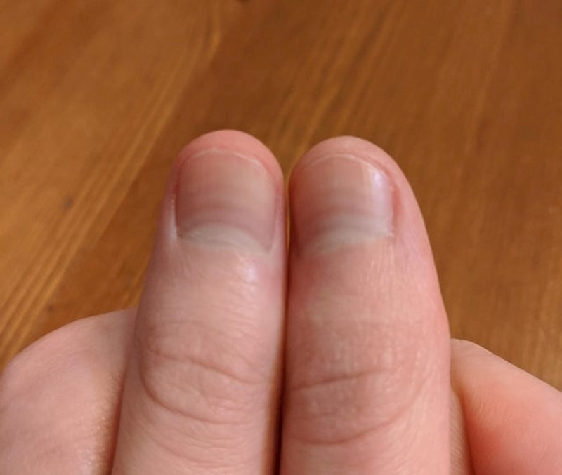 14. „Prošao sam 4 kruga kemoterapije. Kao jedna od posljedica - na mojim su se noktima stvorile pruge, i prestali su rasti. "