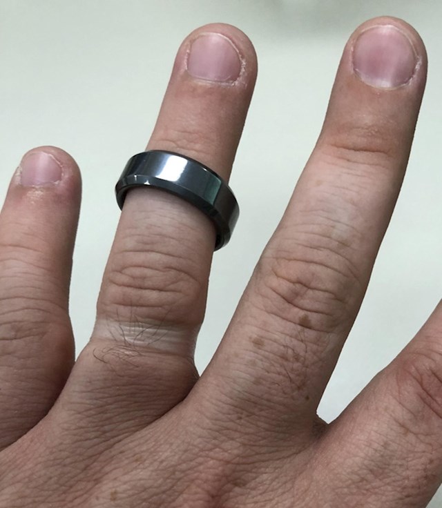 8. Promjena koju je na prstu izazvao vjenčani prsten tijekom 7 godina