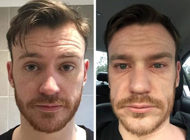 2. Njegovo lice prije i nakon alergijske reakcije