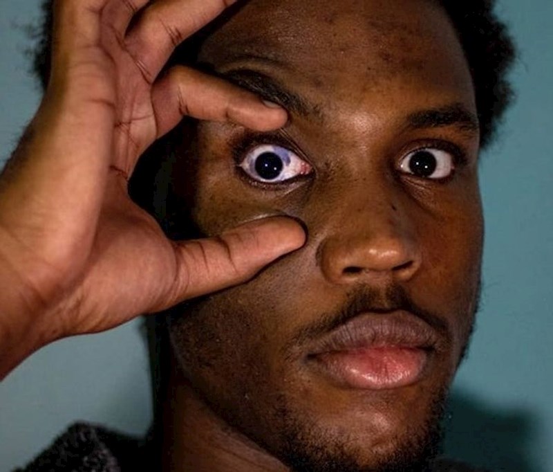 16. Imam madež usred oka...